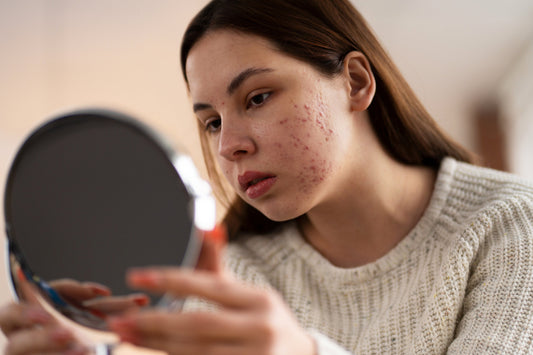 The Ultimate Guide to Fading Acne Scars Naturally